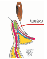 グラマラスライン　下眼瞼下制術