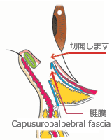 グラマラスライン　下眼瞼下制術