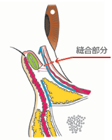 グラマラスライン　下眼瞼下制術