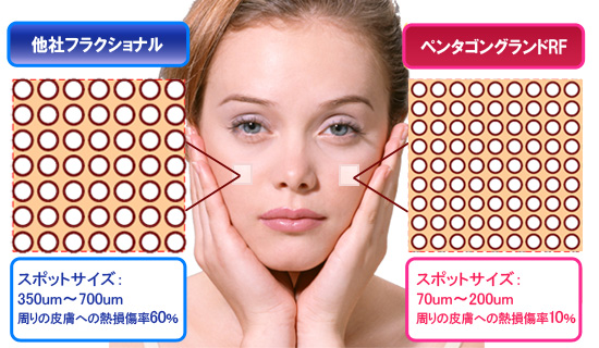 スポットの大きさ説明画像