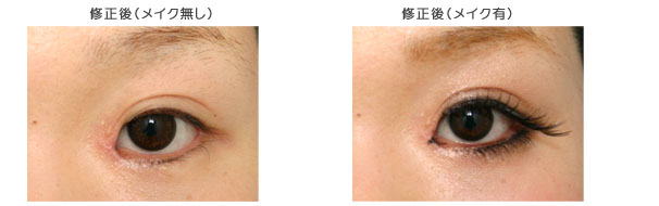 蒙古襞形成