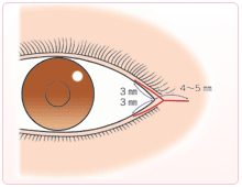目尻切開　切開部分