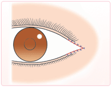 目尻切開　広げて外側に伸ばす