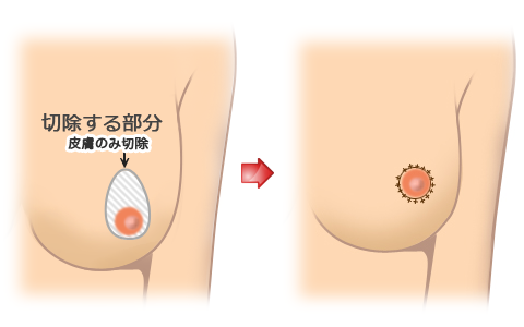乳房吊り上げ