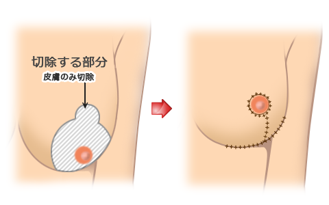 乳房吊り上げ