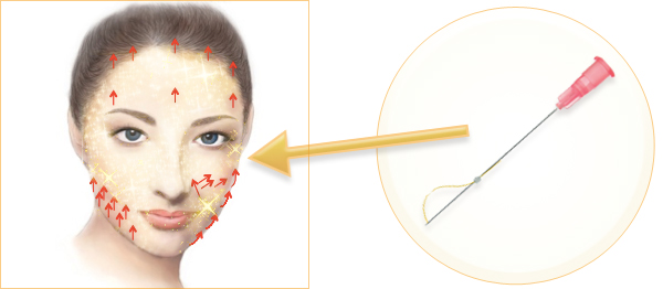 アンチエイジング Antiaging ‐ 溶ける金の糸(レインボーリフト)