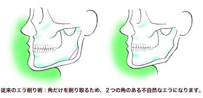 従来のエラ削り術説明画像