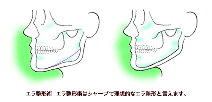 ヴェリテ式術説明画像