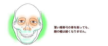 薄い頬骨弓を削っても、顔の幅は細くなりません