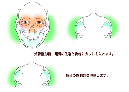 頬骨整形術