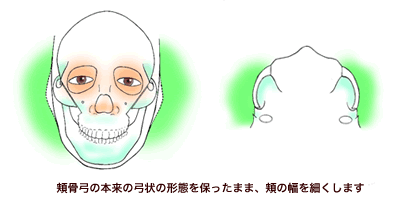 頬骨弓の形態を保ったまま、頬の幅を細くします