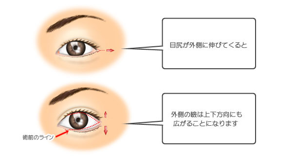目尻切開