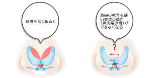 鼻尖縮小