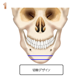 アゴ切り アゴ削り 美容整形 美容外科ならヴェリテクリニック 公式 東京 名古屋 大阪