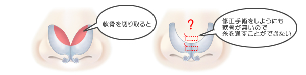 鼻尖縮小