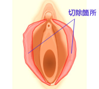 大陰唇