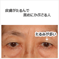 眼瞼下垂