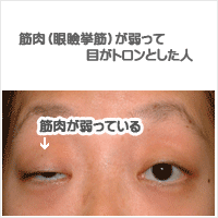 眼瞼下垂