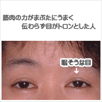 眼瞼下垂