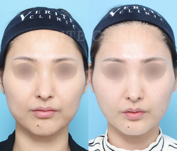 顔の脂肪吸引+糸リフトの症例写真