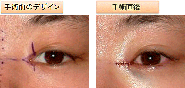 蒙古襞形成のビフォーアフター症例画像