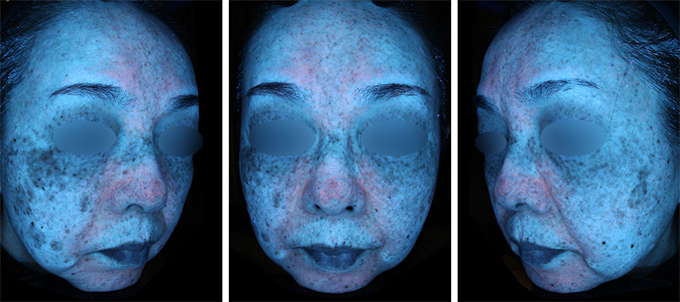 ゼオスキンヘルス（ZO SKIN HEALTH）の症例写真