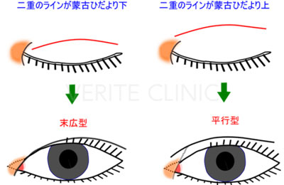 蒙古ひだと二重の関係