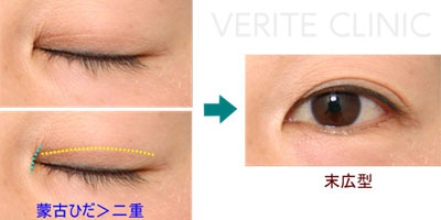 蒙古ひだより二重のラインが下