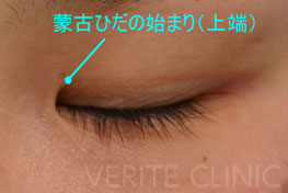 蒙古ひだの始まり