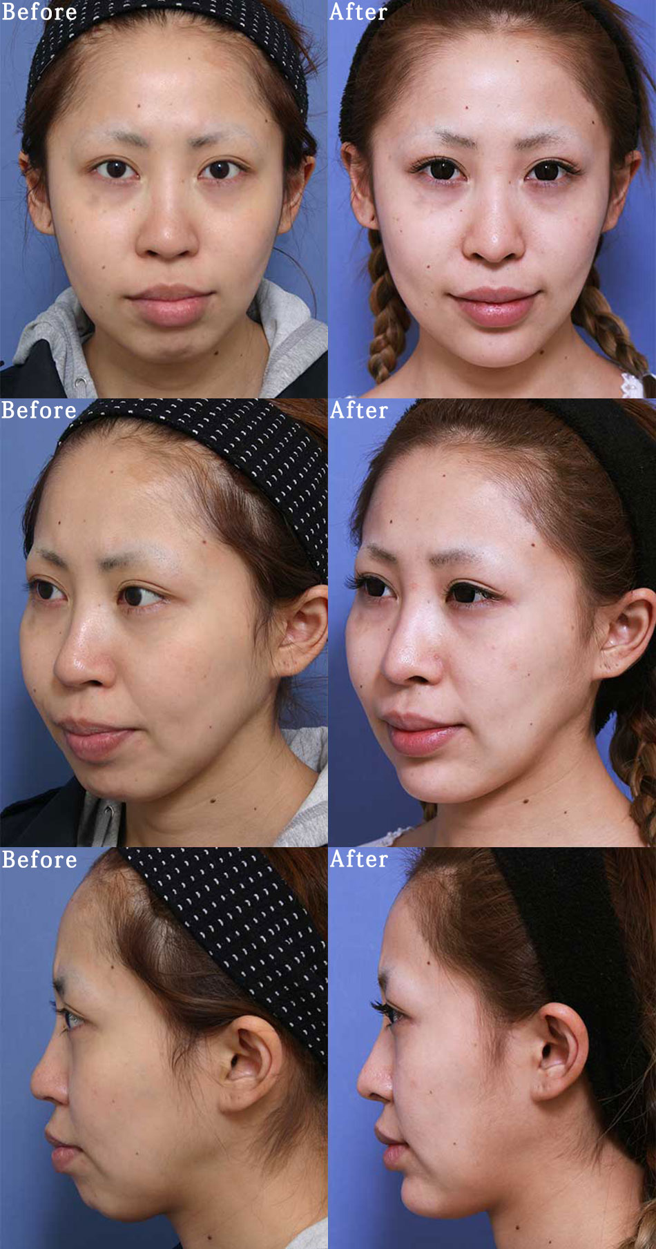 鼻尖縮小術の症例写真 (2) - サムネイル