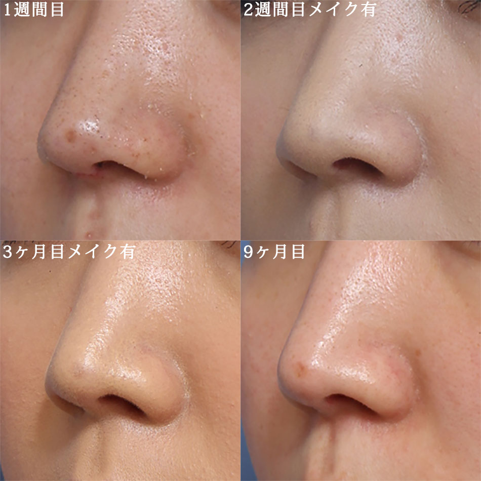 鼻中隔延長術＋保存軟骨移植術の症例写真 (4) - サムネイル