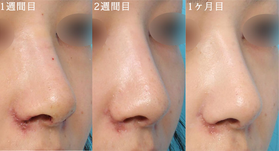 鼻プロテーゼ（隆鼻術）の症例写真 (4) - サムネイル