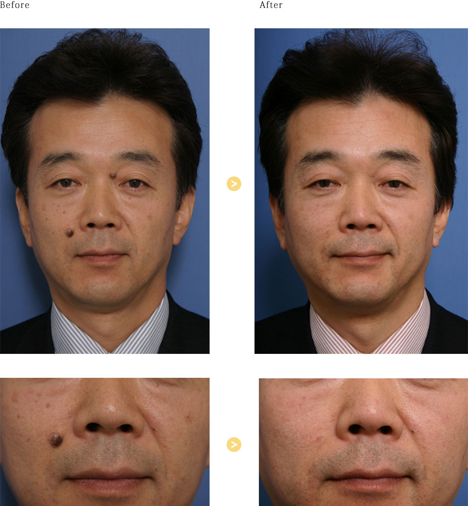 黒子CO2レーザーの症例写真
