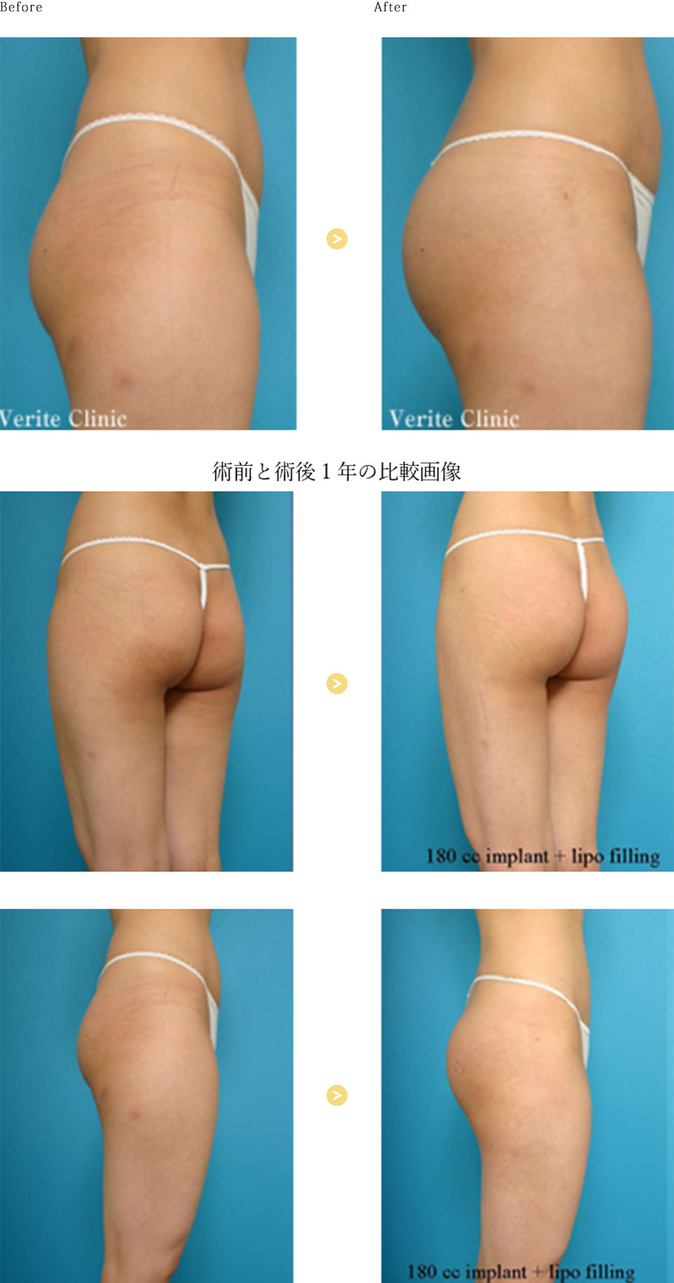臀部プロテーゼの症例写真
