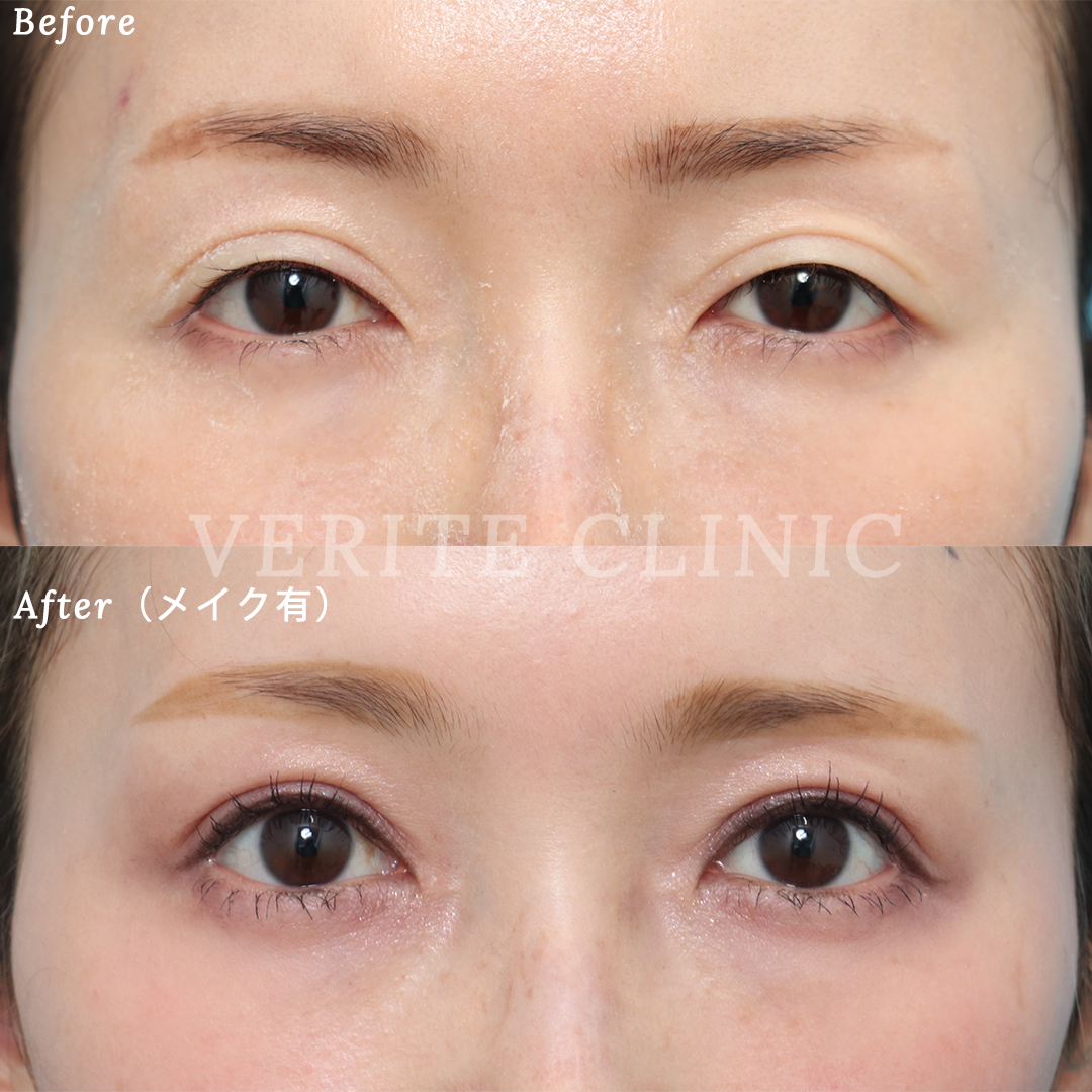 美容眼瞼下垂手術テキスト（英語版） 美容眼瞼下垂手術テキスト（英語