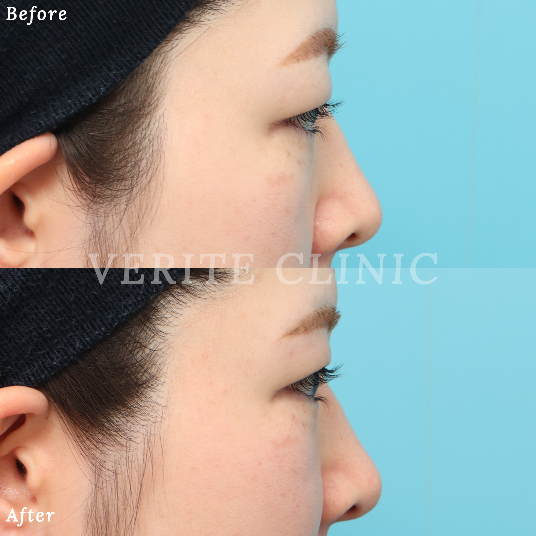 上眼瞼リフト（眉下切開）| 美容整形・美容外科のヴェリテクリニック