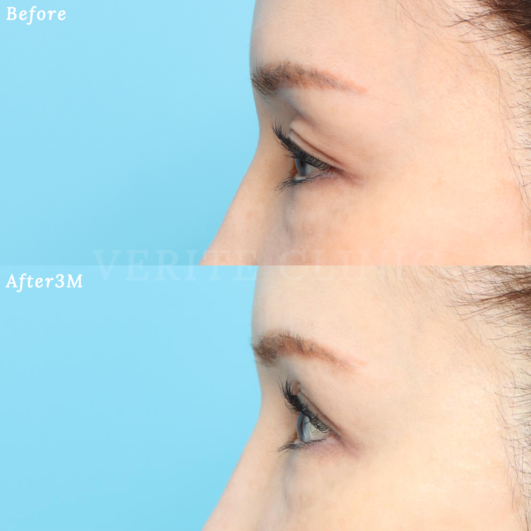 上眼瞼リフトで窪んだ目元を改善| 美容整形・美容外科のヴェリテ