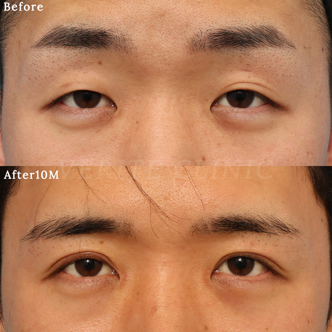 美容眼瞼下垂手術テキスト（英語版） 美容眼瞼下垂手術テキスト（英語版） 美容眼瞼下垂手術テキスト（英語