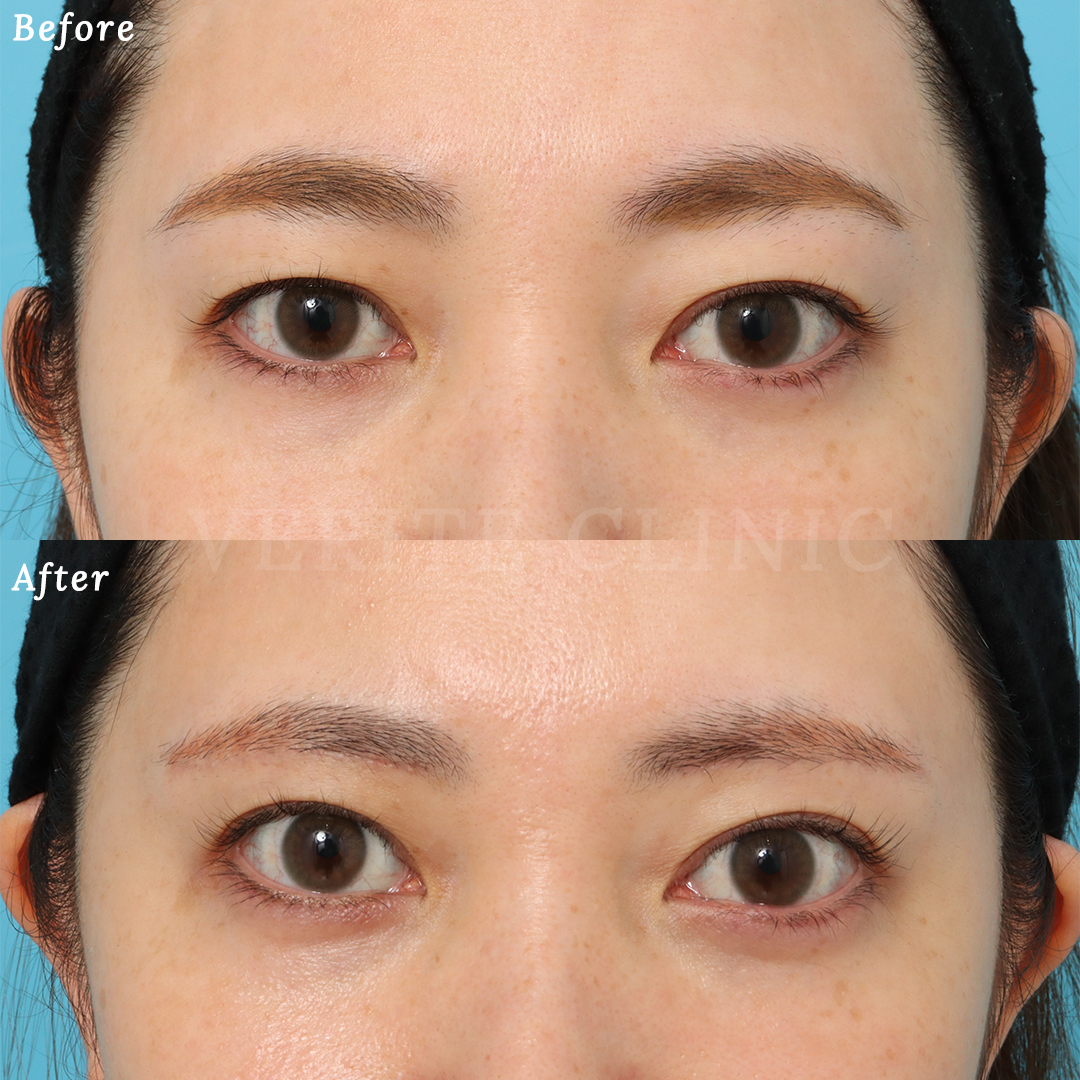 上眼瞼リフト（眉下切開）の症例写真