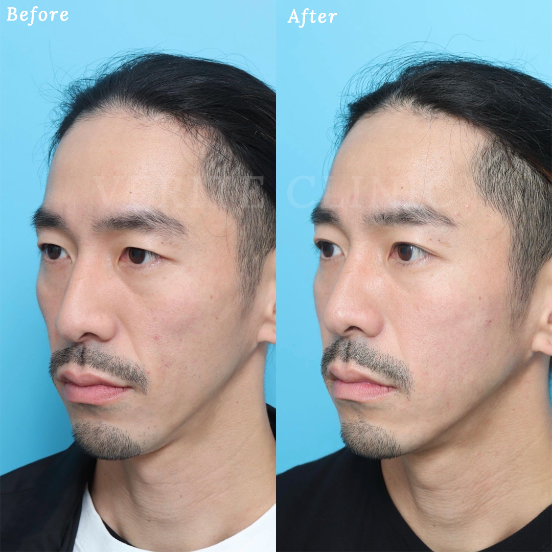 ヒアルロン酸注入の症例写真 (2) - サムネイル