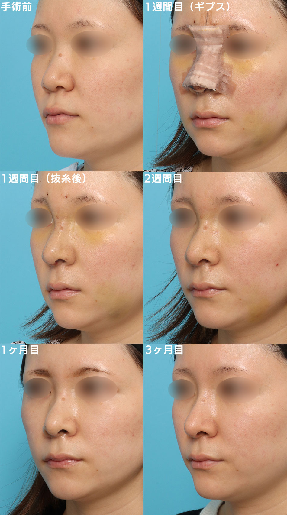 隆鼻術＋眉間プロテーゼの症例写真 (4) - サムネイル
