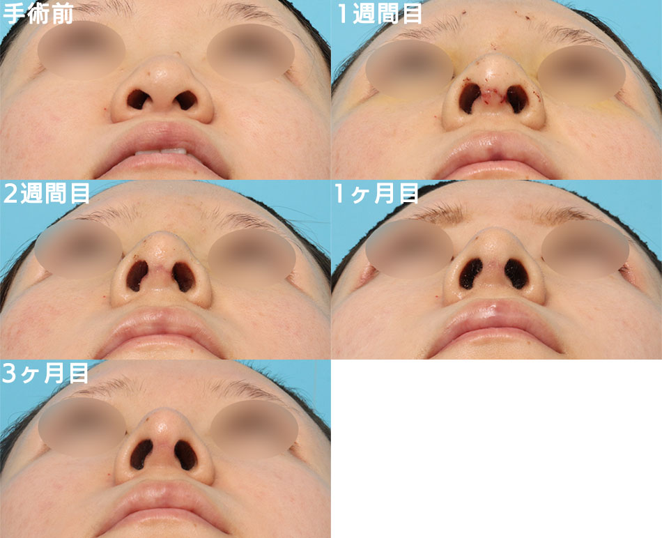 隆鼻術＋眉間プロテーゼの症例写真 (5) - サムネイル