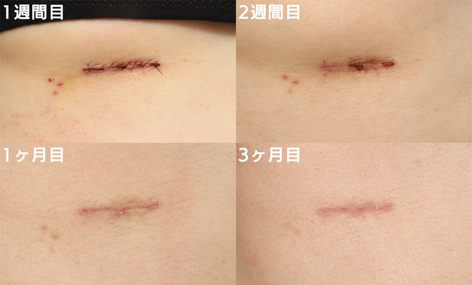 隆鼻術＋眉間プロテーゼの症例写真 (6) - サムネイル
