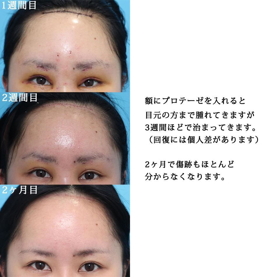 隆鼻術＋眉間プロテーゼの症例写真 (4) - サムネイル