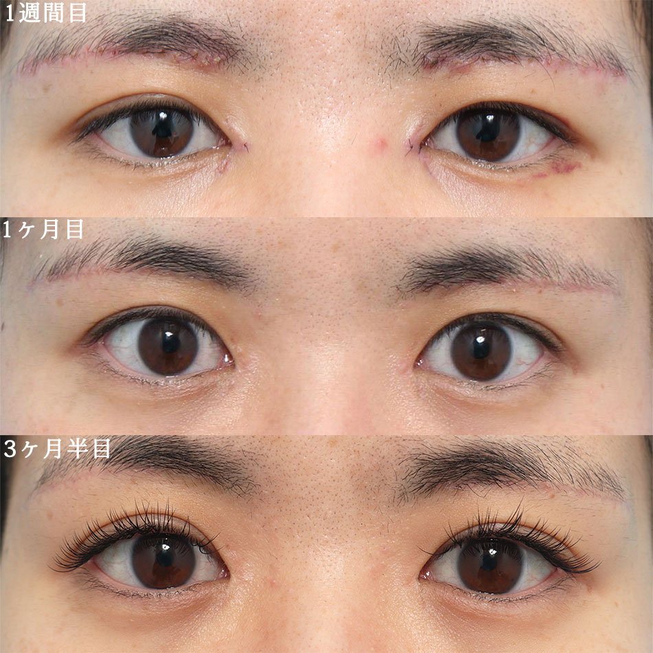 上眼瞼リフト（眉下切開）の症例写真 (2) - サムネイル