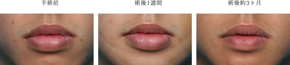 口唇縮小術の症例写真
