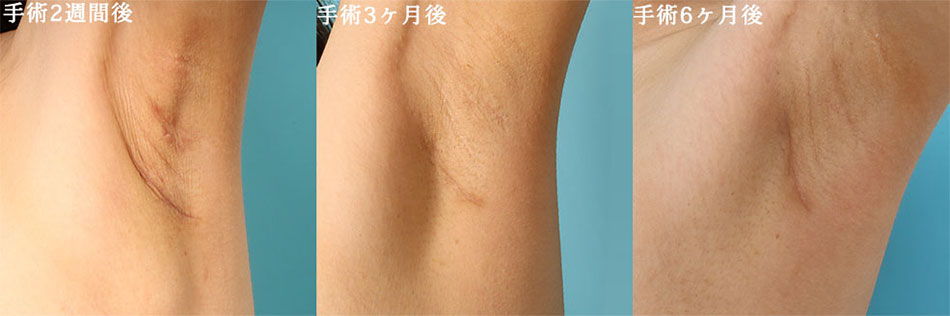 豊胸術 (シリコンバッグ)の症例写真 (3) - サムネイル