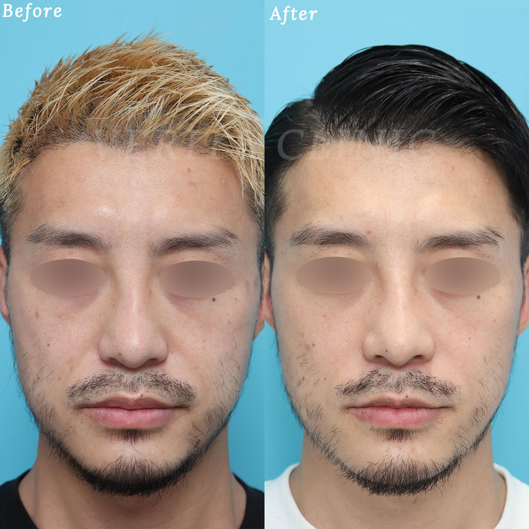 鼻翼基部オーダープロテーゼのビフォーアフターの症例画像（正面）