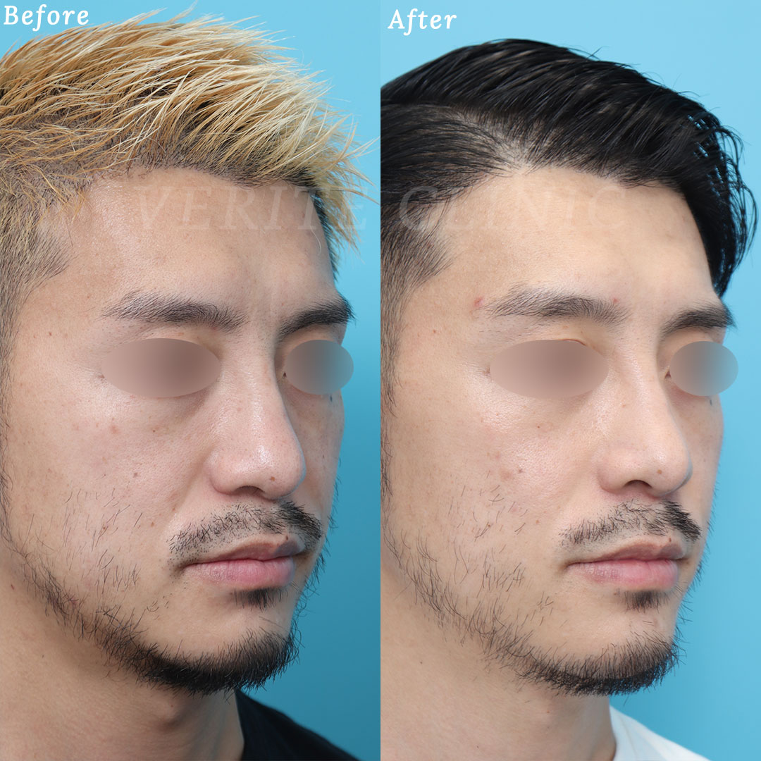 鼻翼基部オーダープロテーゼのビフォーアフターの症例画像（ななめ）