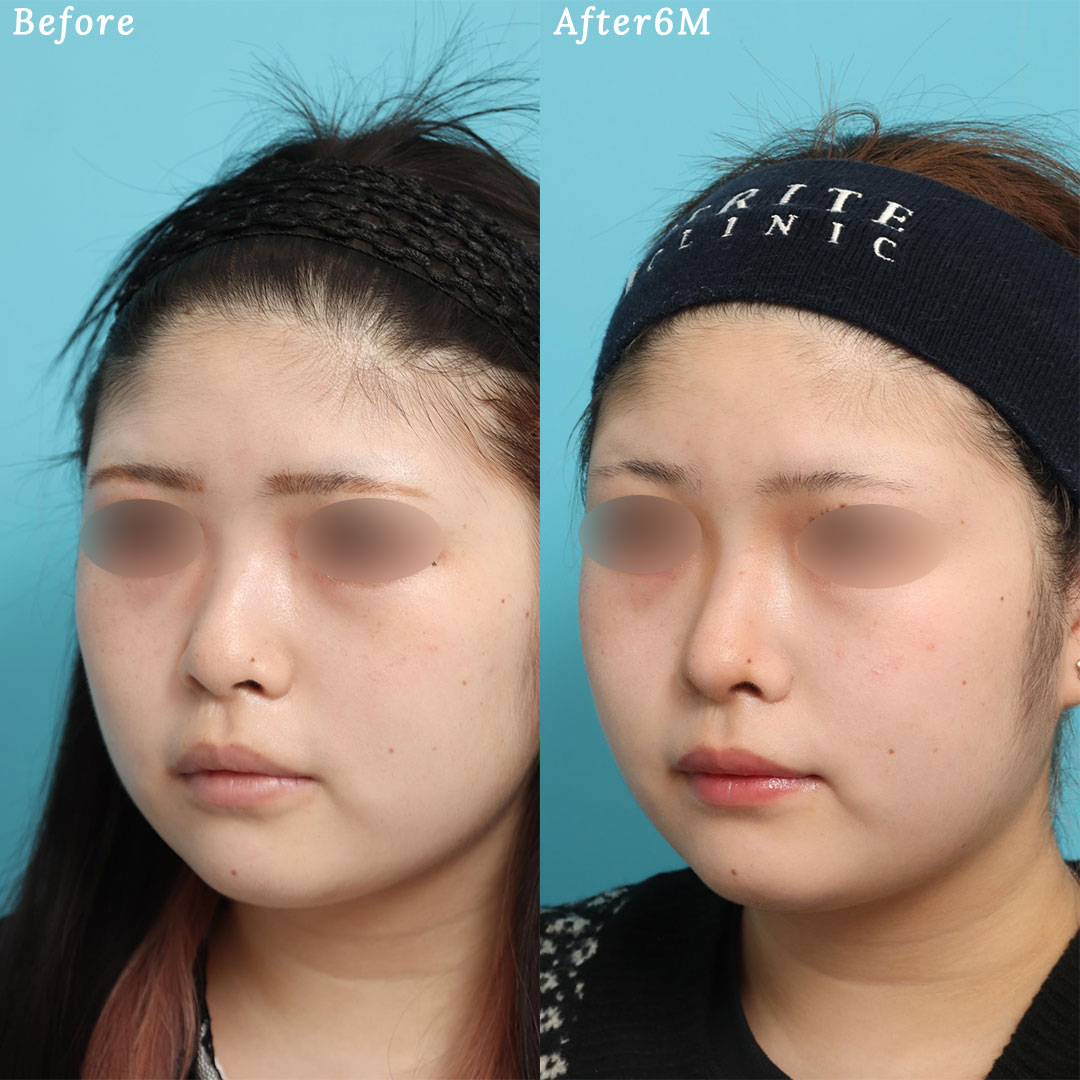 鼻尖形成＋鼻尖縮小の症例写真 (1) - サムネイル